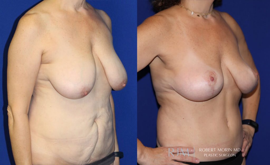  Woman's body, before and after Breast Augmentation treatment in New Jersey, front view, patient 33