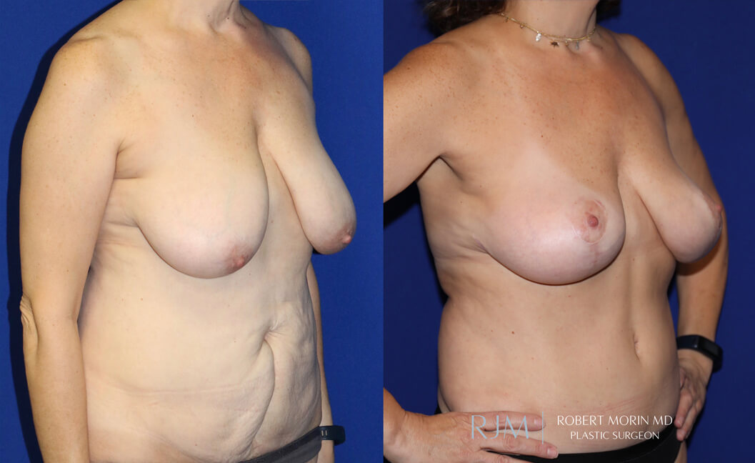  Woman's body, before and after Breast Augmentation treatment, front view, patient 30