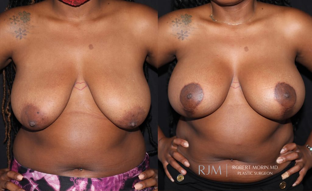  Woman's body, before and after Breast Augmentation treatment in New Jersey, front view, patient 32