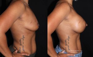  Woman's body, before and after Breast Augmentation treatment, r-side view, patient 6
