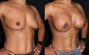  Woman's body, before and after Breast Augmentation treatment, oblique view, patient 6