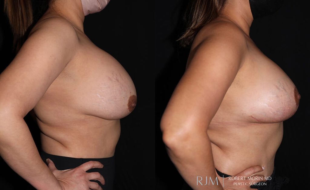  Woman's body, before and after Breast Augmentation treatment in New Jersey, r-side view, patient 36