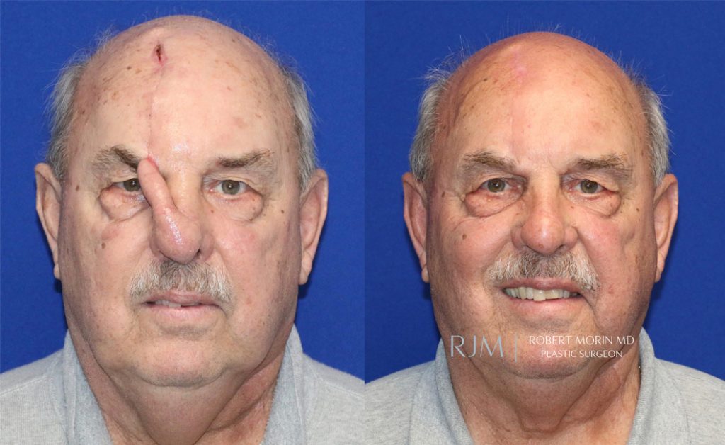  Male face, before and after Complex Nasal Reconstruction treatment in New Jersey, front view (thrown back), patient 1