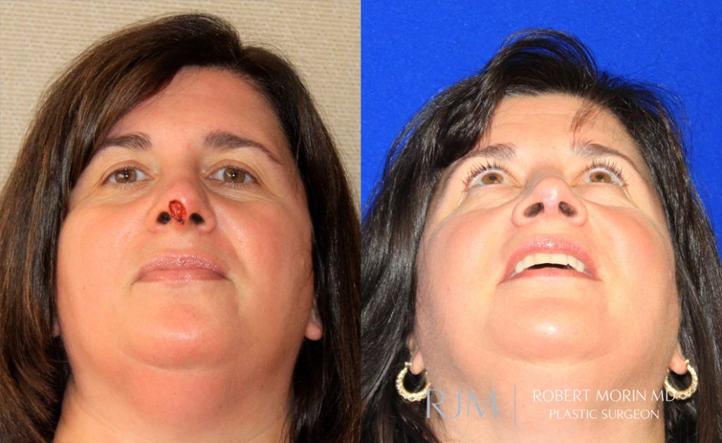 Woman's face, before and after Complex Nasal Reconstruction treatment in New Jersey, front view (thrown back), patient 3