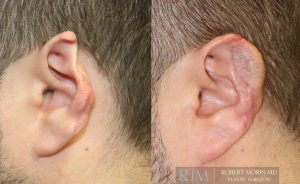  Male ear, before and after Ear Reconstruction treatment, side view, patient 1
