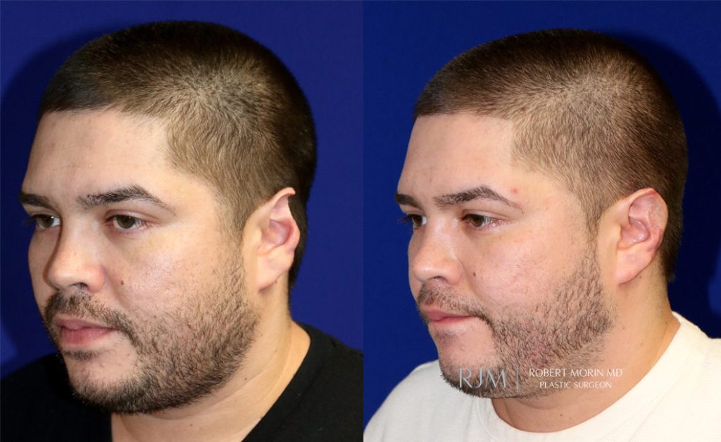  Male face, before and after Ear Reconstruction treatment in New Jersey, oblique view, patient 1