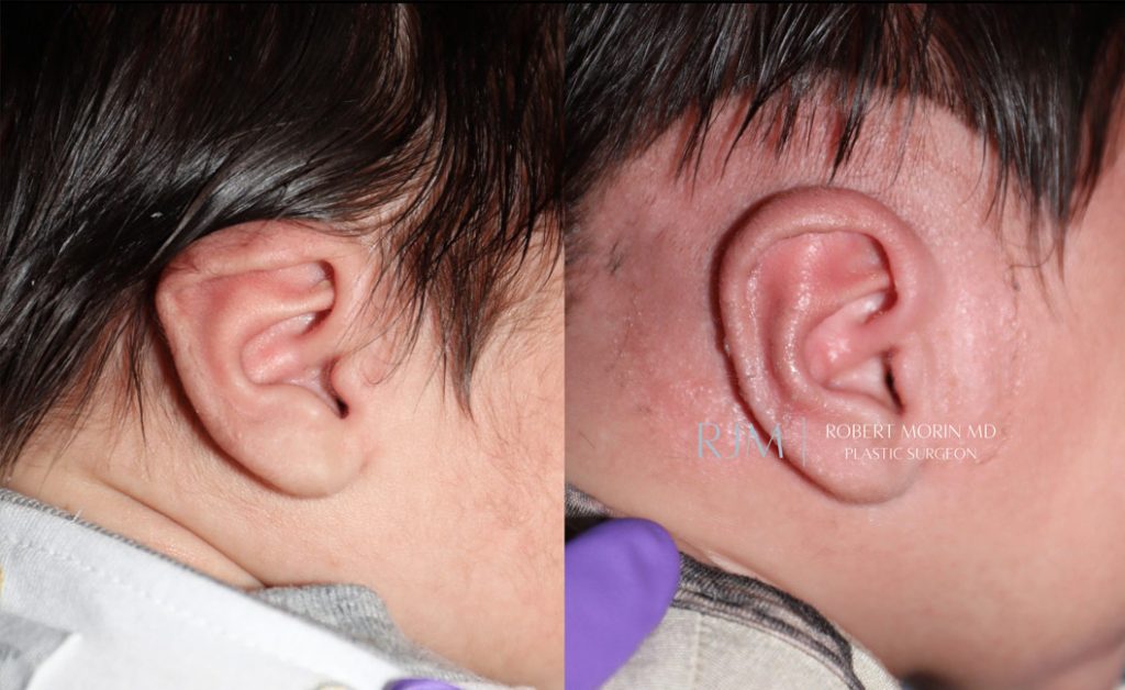  Infant ear, before and after EarWell Infant Ear Molding treatment, r-side view, patient 3