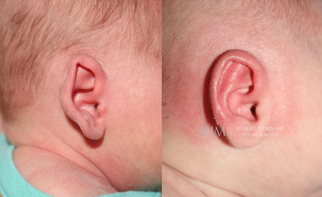  Infant ear, before and after EarWell Infant Ear Molding treatment, r-side view, patient 4
