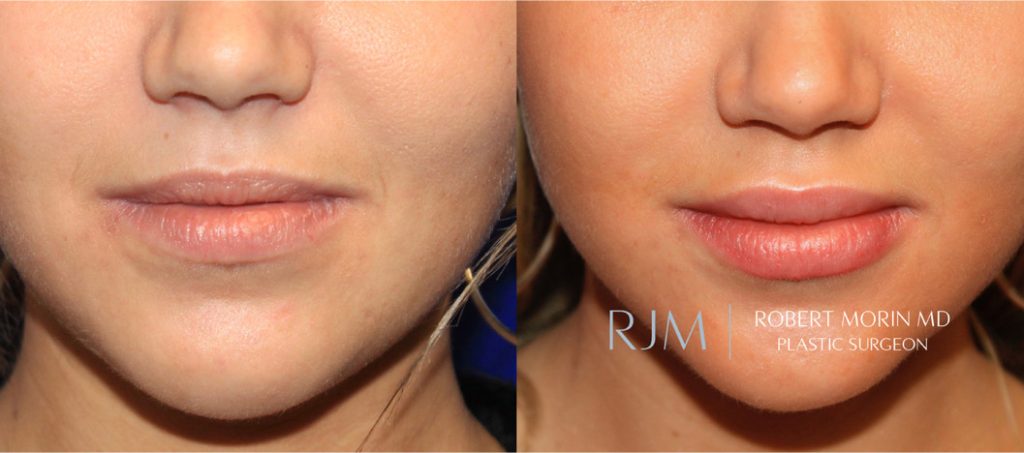  Woman's face, before and after lip augmentation treatment in New Jersey, front view, patient 5