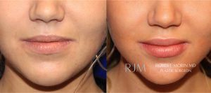  Woman's face, before and after lip augmentation treatment, front view, patient 1