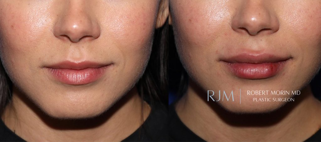  Woman's face, before and after lip augmentation treatment in New Jersey, front view, patient 6
