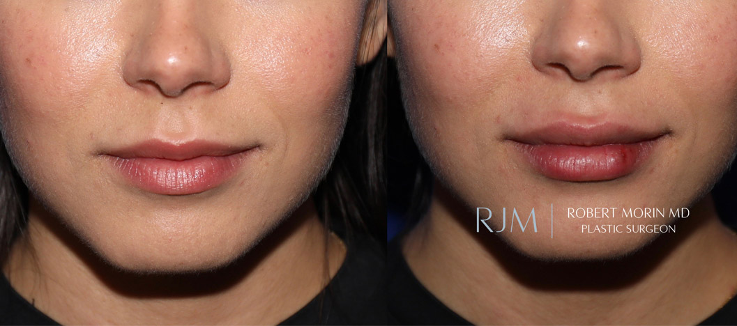  Woman's face, before and after lip augmentation treatment, front view, patient 2