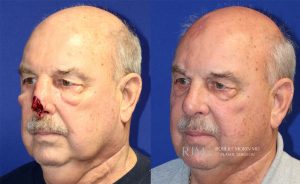  Male face, before and after Mohs/Skin Cancer Reconstruction treatment, oblique view, patient 2
