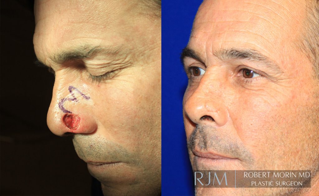  Male face, before and after Mohs/Skin Cancer Reconstruction treatment in New Jersey, oblique view, patient 3