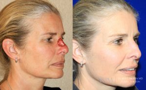  Woman's face, before and after Mohs/Skin Cancer Reconstruction treatment, oblique view, patient 4