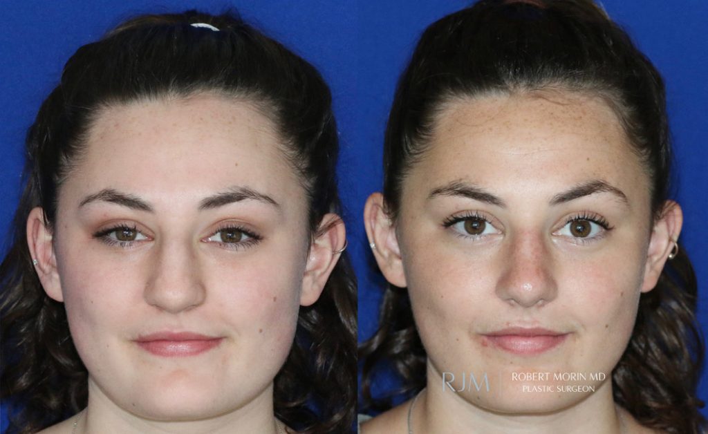  Woman's face, before and after Nasal Bone Fracture Repair treatment, front view, patient 2