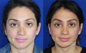  Woman's face, before and after Revision Rhinoplasty treatment, front view, patient 1
