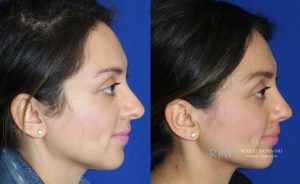  Woman's face, before and after Revision Rhinoplasty treatment, r-side view, patient 1