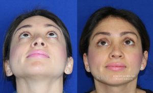  Woman's face, before and after Revision Rhinoplasty treatment, front view (thrown back), patient 1