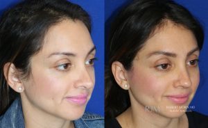  Woman's face, before and after Revision Rhinoplasty treatment, oblique view, patient 1