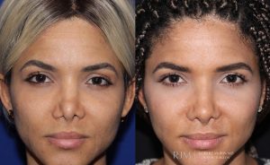  Woman's face, before and after Revision Rhinoplasty treatment, front view, patient 2