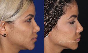  Woman's face, before and after Revision Rhinoplasty treatment, r-side view, patient 2