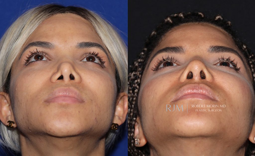  Woman's face, before and after Revision Rhinoplasty treatment in New Jersey, front view (thrown back), patient 1