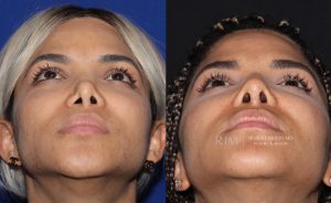  Woman's face, before and after Revision Rhinoplasty treatment, front view (thrown back), patient 2