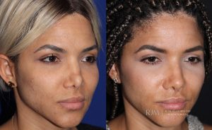  Woman's face, before and after Revision Rhinoplasty treatment in New Jersey, oblique view, patient 1