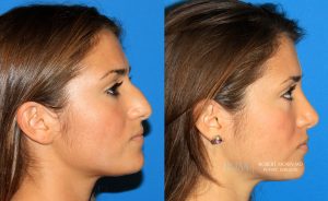 Female face, before and after rhinoplasty treatment, r-side view, patient 1
