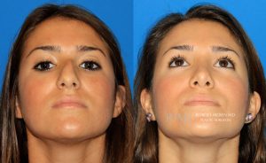  Female face, before and after rhinoplasty treatment, front view (thrown back) - patient 1
