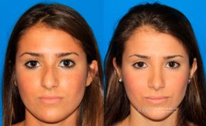  Female face, before and after rhinoplasty treatment, front view, patient 1