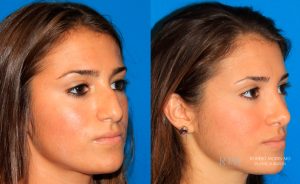  Female face, before and after rhinoplasty treatment, oblique view, patient 1