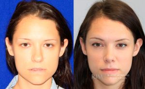  Female face, before and after rhinoplasty treatment, front view, patient 23
