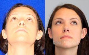  Female face, before and after rhinoplasty treatment, front view (thrown back) - patient 23