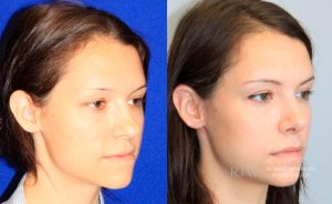  Female face, before and after rhinoplasty treatment, oblique view, patient 23