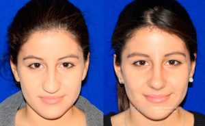  Female face, before and after rhinoplasty treatment, front view, patient 24