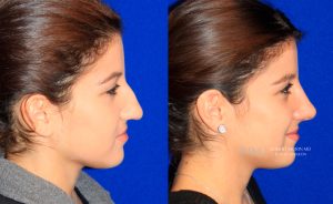 Female face, before and after rhinoplasty treatment, r-side view, patient 24