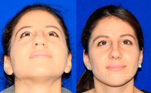  Female face, before and after rhinoplasty treatment, front view (thrown back) - patient 24