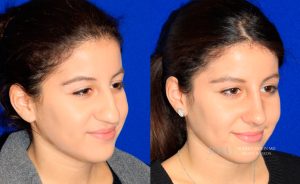  Female face, before and after rhinoplasty treatment, oblique view, patient 24