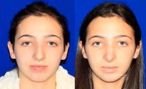  Female face, before and after rhinoplasty treatment, front view, patient 25