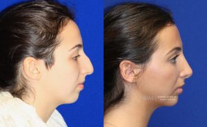  Female face, before and after rhinoplasty treatment, r-side view, patient 25