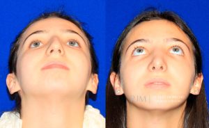  Female face, before and after rhinoplasty treatment, front view (thrown back) - patient 25