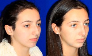  Female face, before and after rhinoplasty treatment, oblique view, patient 25