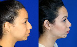  Female face, before and after rhinoplasty treatment, r-side view, patient 21