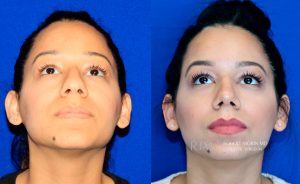  Female face, before and after rhinoplasty treatment, front view (thrown back) - patient 21