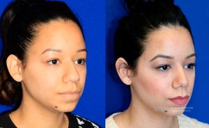  Female face, before and after rhinoplasty treatment, oblique view, patient 21