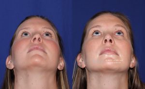  Female face, before and after rhinoplasty treatment, front view (thrown back) - patient 14