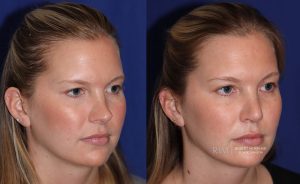  Female face, before and after rhinoplasty treatment, oblique view, patient 14