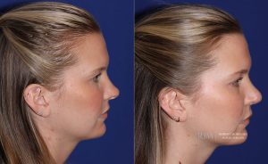  Female face, before and after rhinoplasty treatment, r-side view, patient 14